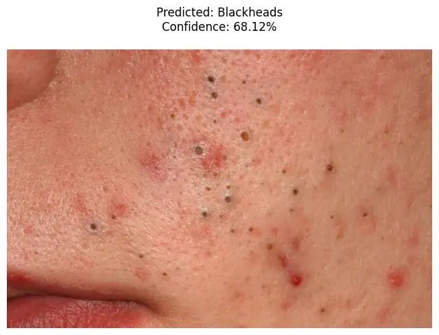 Detecting Acne